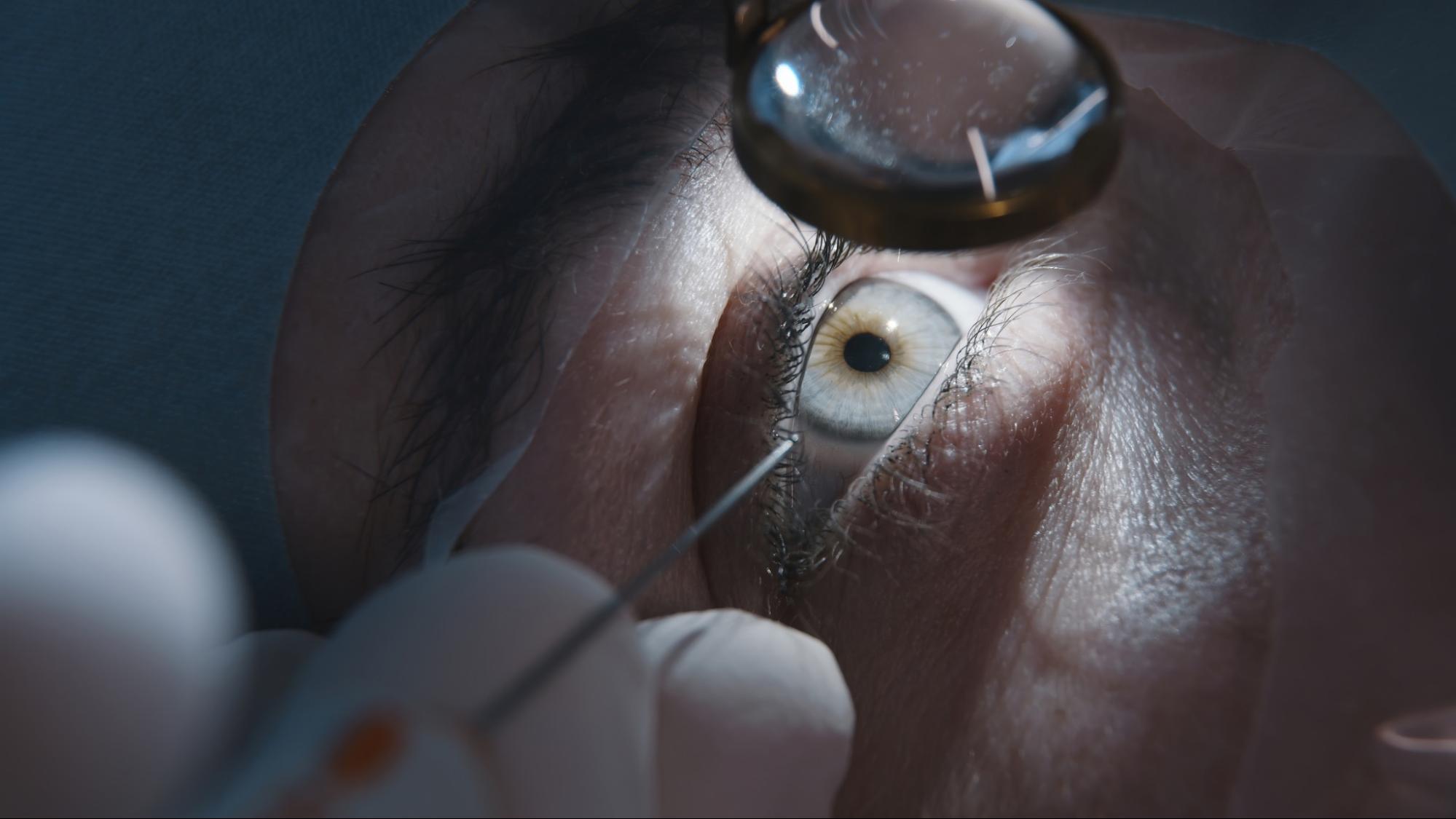 Cataract Treatment